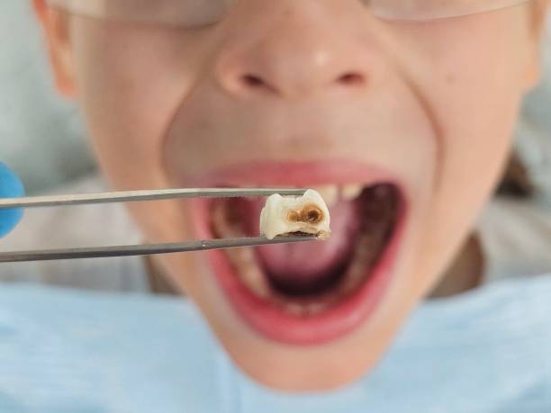 Best Emergency Wisdom Teeth Removal in Brunswick, NC