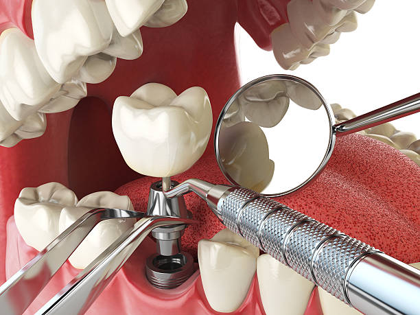 Best Emergency Treatment for Dental Infections or Abscesses in Brunswick, NC
